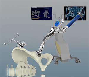 Computer Assisted Hip Replacement
