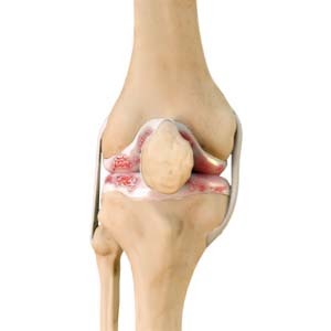 Arthritis of the Knee