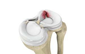 Meniscus Tears